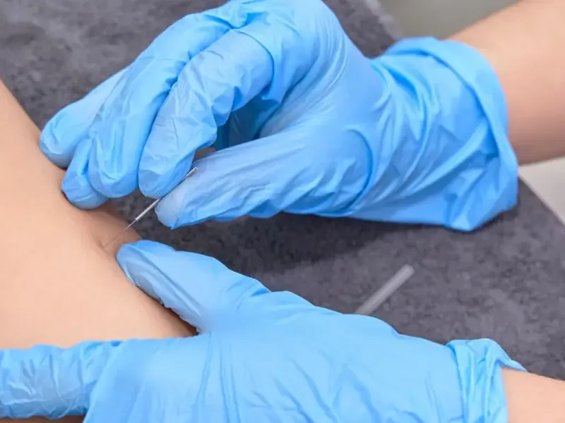 Clinician performing dry needling on a patient