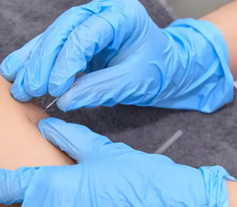 Clinician performing dry needling on a patient